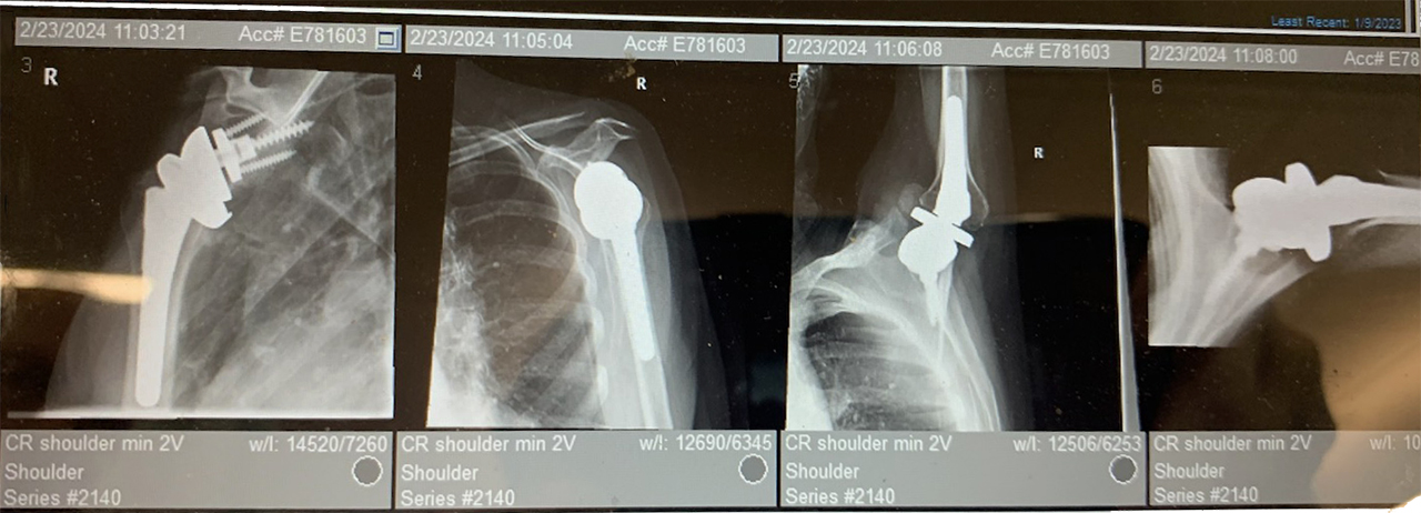 Right shoulder x-rays of Mary Hunter